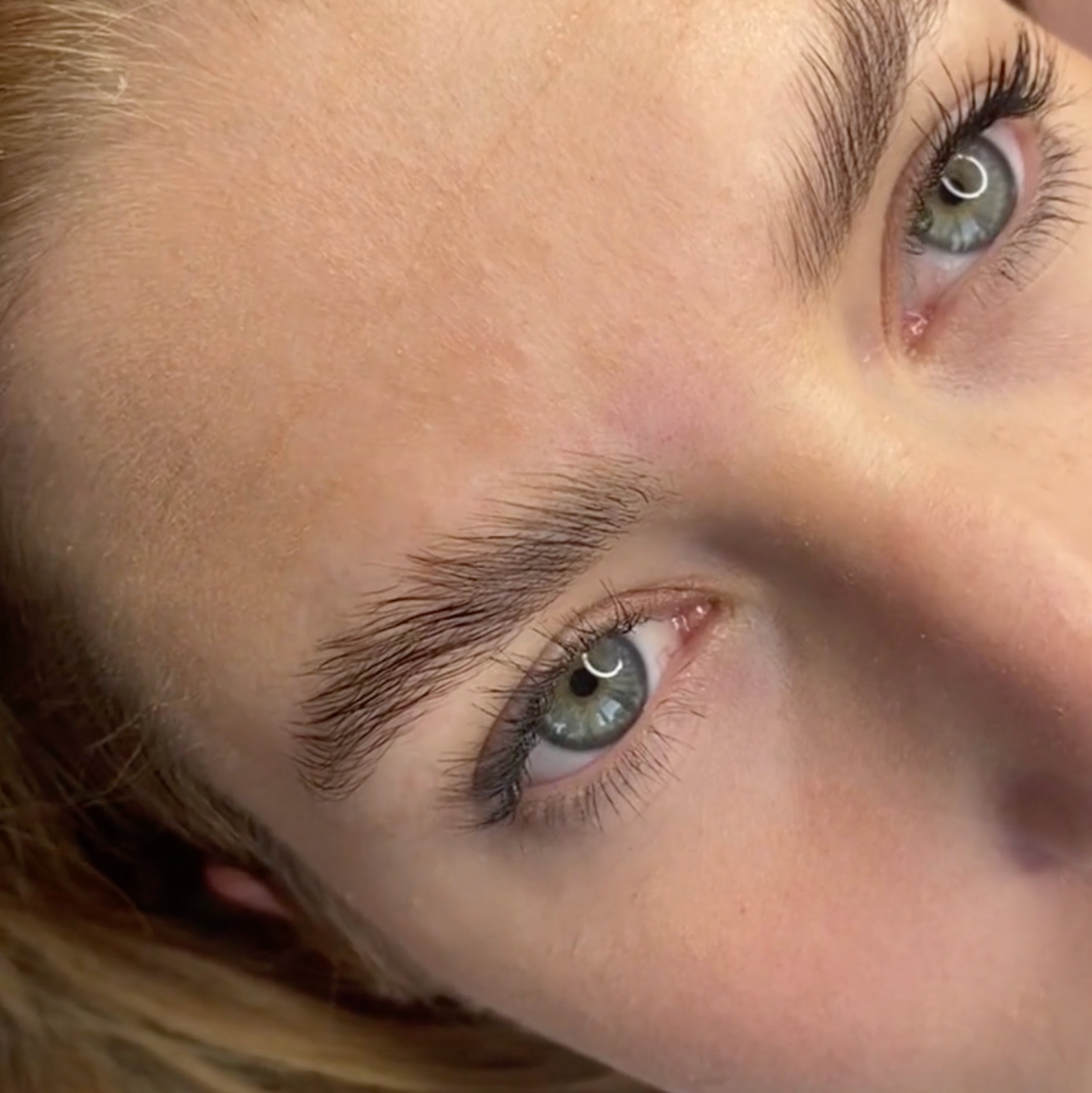 Browlift Video