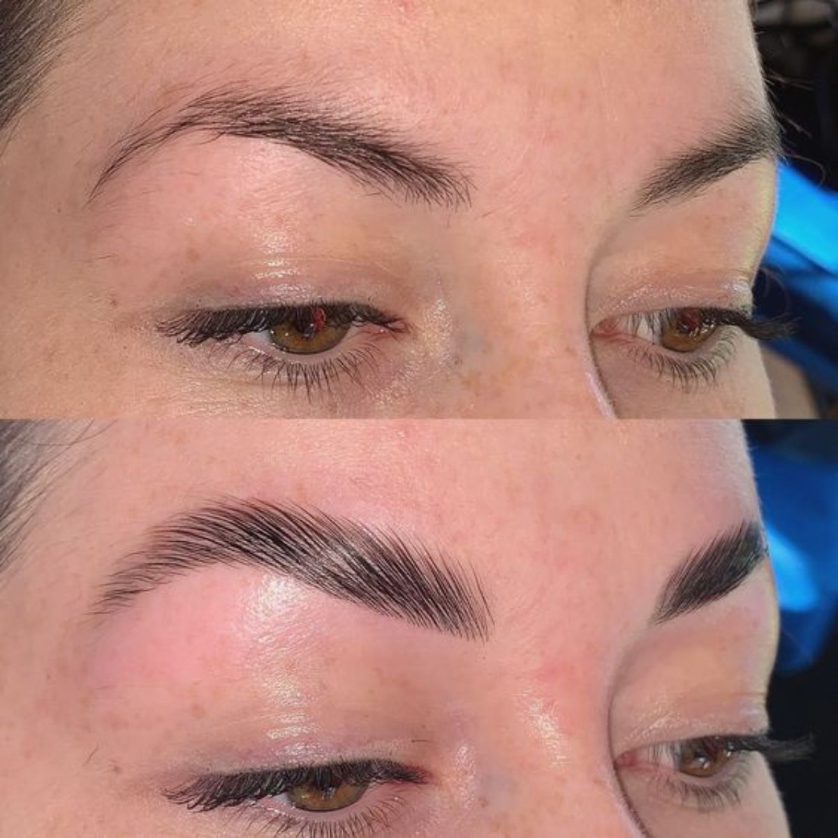 Browlift Starter Kit